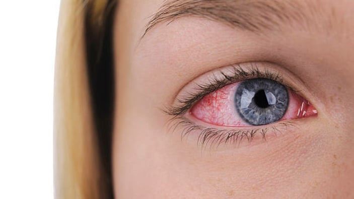 Göz kızarıklığının sebebi adenovirüs olabilir
